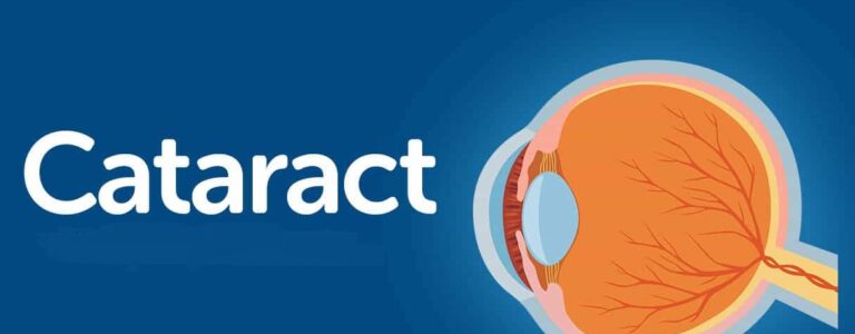 Cataracts in Children