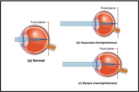 Refractive Error2